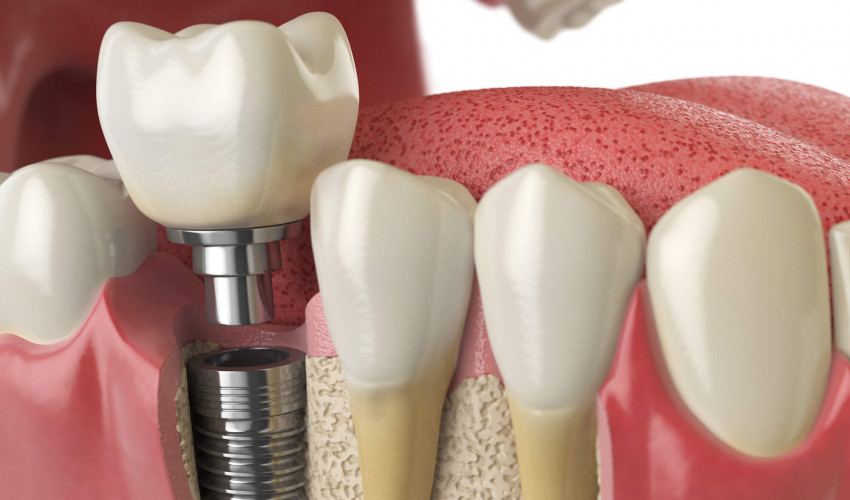 Zahnarzt Stendal — Implantate